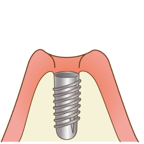 STEP2 １次手術（インプラントを骨に埋入する手術）